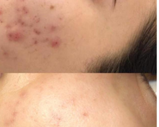 acne